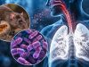 Se activa alerta mundial por presunto brote de peste pulmonar